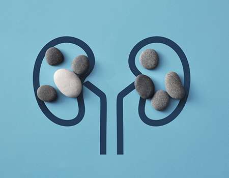 Your Answer to Hyperoxaluria and Stone Prevention 6 Your Answer to Hyperoxaluria and Stone Prevention Hyperoxaluria
